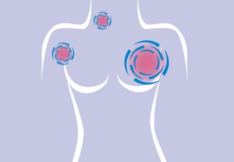 سرطان الثدي: تعرّفي على الأعراض والأنواع وطرق