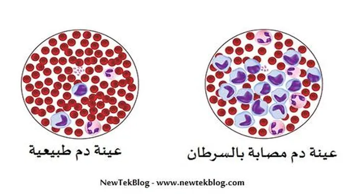 أعراض وأنواع سرطان الدم: اللوكيميا والغدد