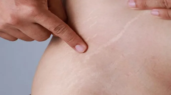 علامات تمدد الجلد (Stretch Marks): الأسباب وطرق